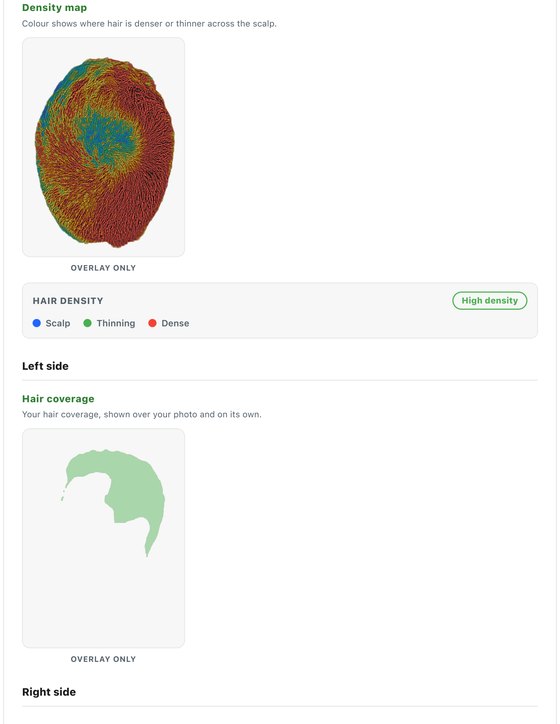 Clinical report - hair density map